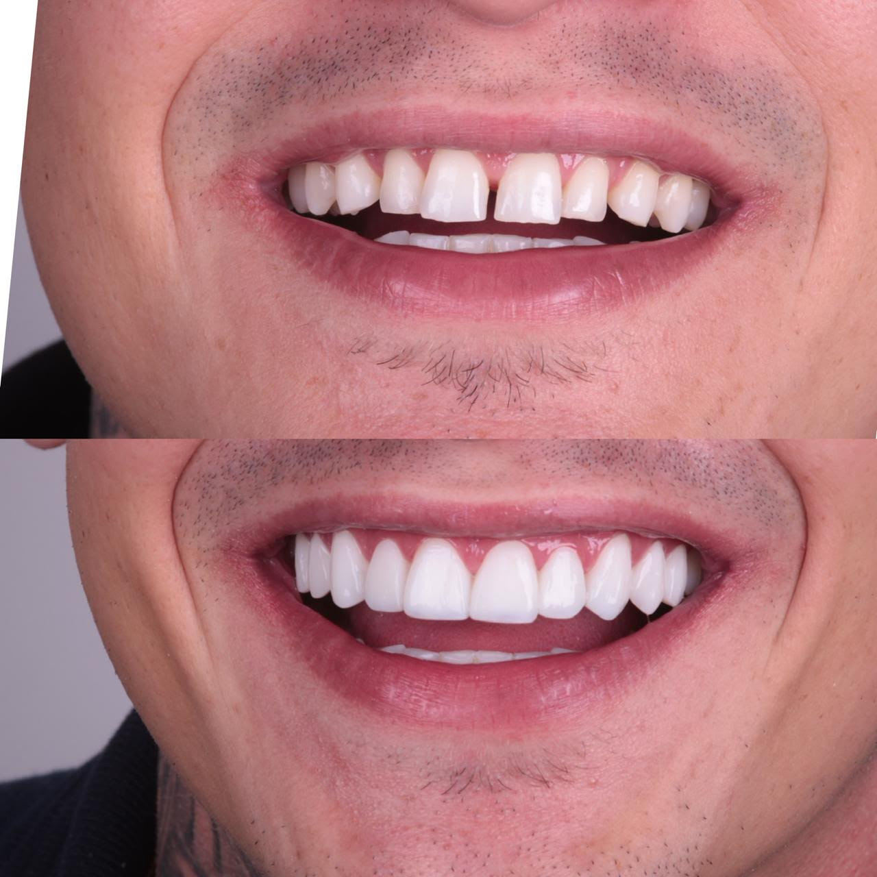 Antes e depois — caso 6
