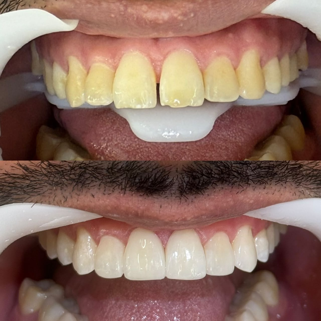 Antes e depois — caso 7